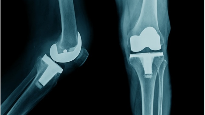 6 Best Knee Replacement Hospitals in India