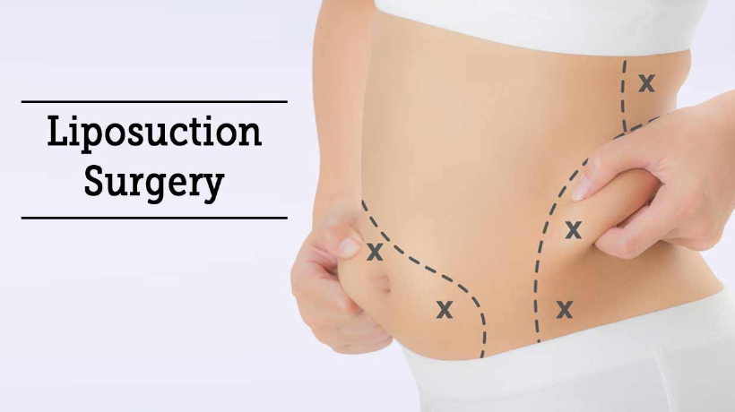 Top 7 Liposuction Centers In India