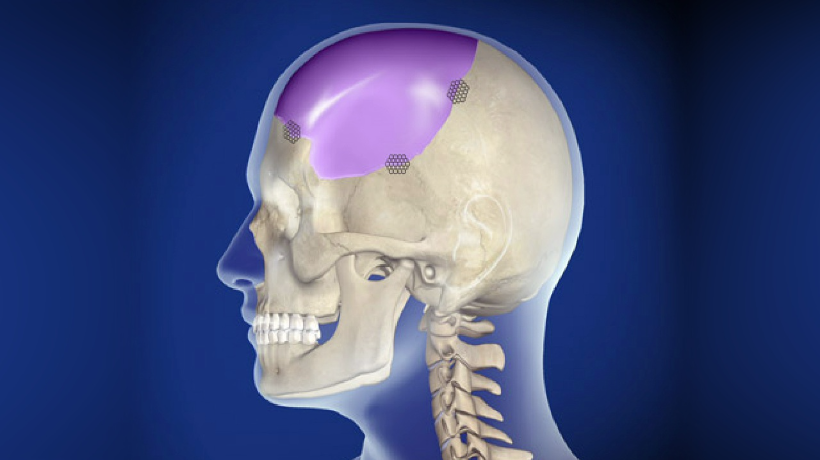 Top 5 Cranioplasty Centres In India