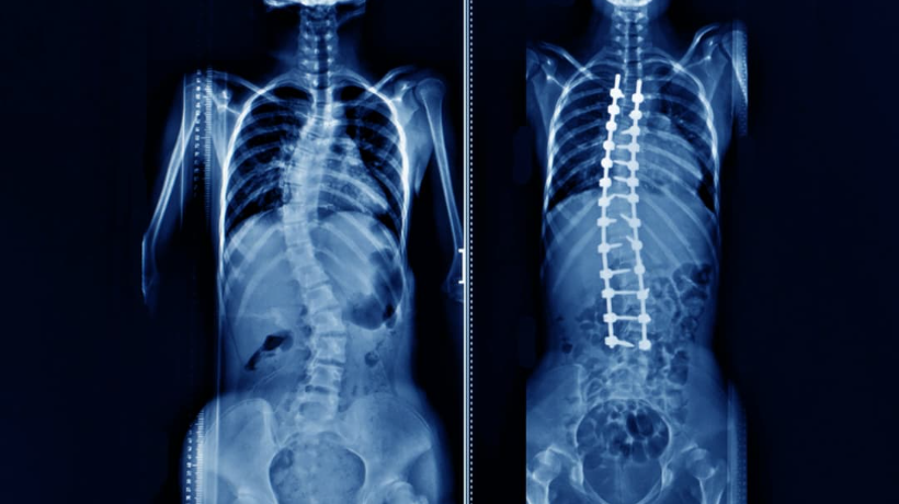 Best Scoliosis Treatment Hospitals In India