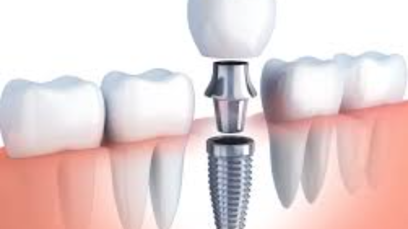 Top 10 Dental Implant Hospitals in India 