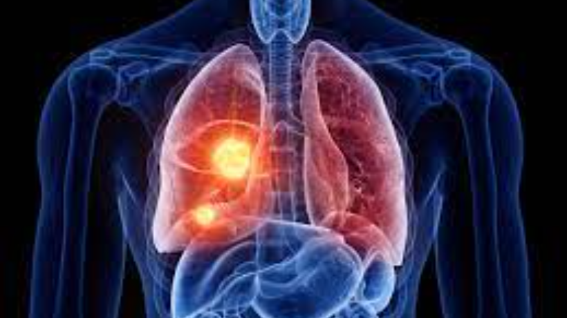 Lung cancer: what, why, how's of the treatment