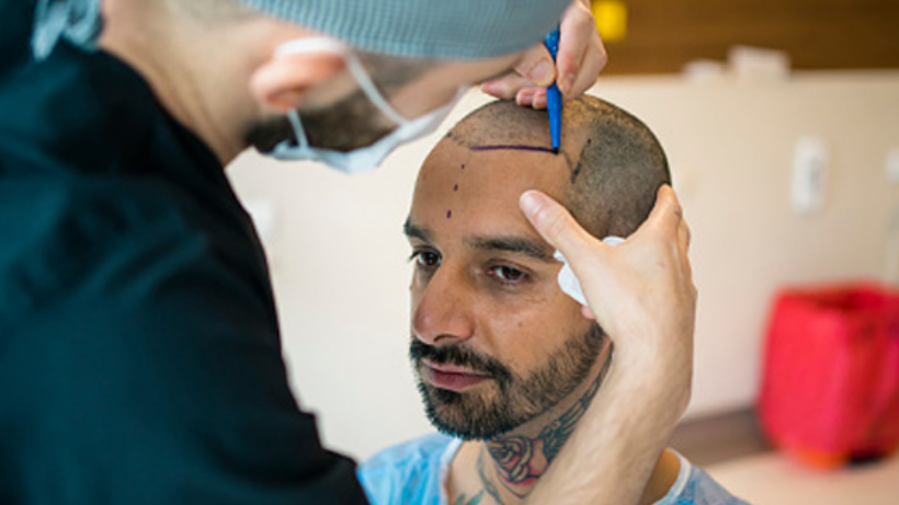 Patient’s FAQ on Hair Transplant Transformation