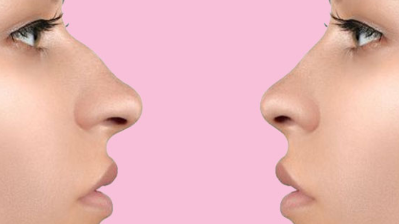 How Much Is a Nose Job In Korea?