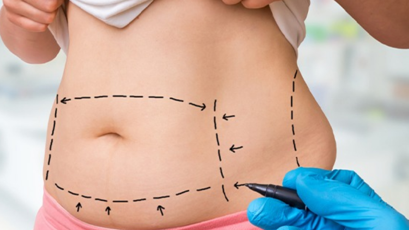 Does Tummy Tuck Cause Stomach Issues?