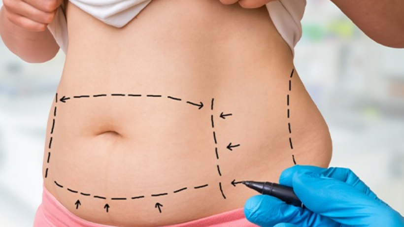 Apakah Tummy Tuck Menyebabkan Masalah Perut?