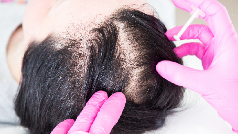 PRF Treatment For Hair Loss: Procedure, Cost, Benefits All You Need To Know