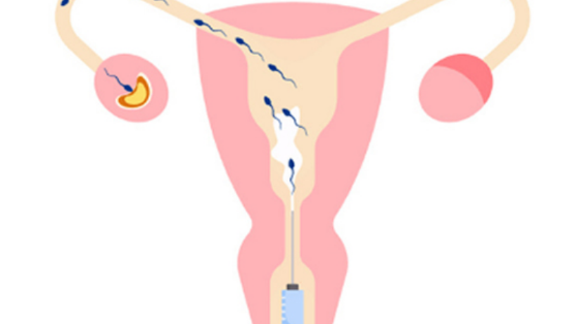 Plan Your Pregnancy With Intrauterine Insemination(IUI)- Here Is How?