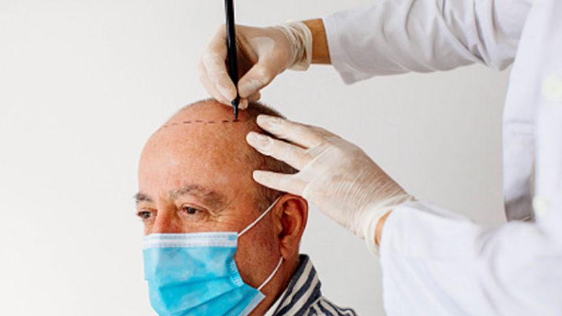 The 5 Important Reasons to Choose Hair Transplant In Turkey