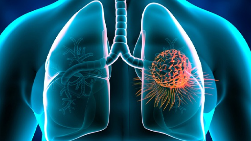 Lung carcinoid tumours vs. common Lung cancers