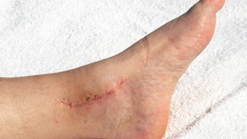 Ankle Repair Surgery- Which One Is Best For You?