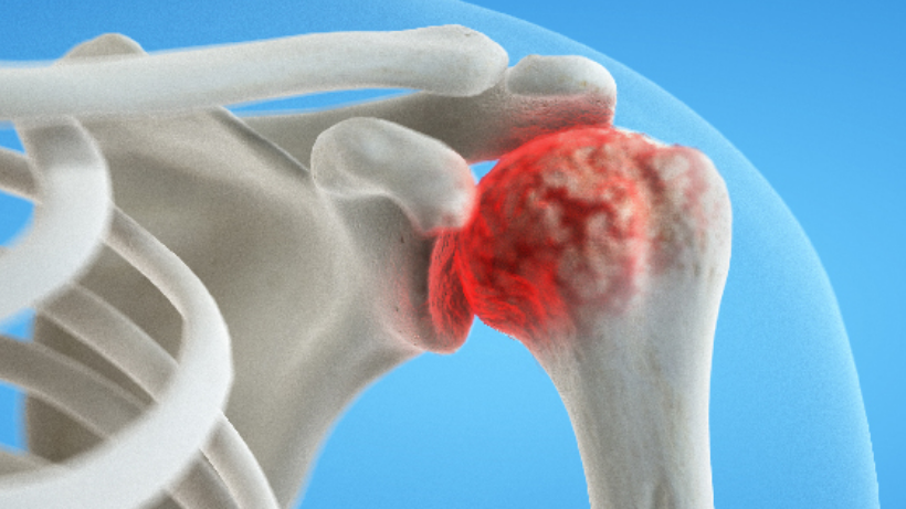 Can You Treat Osteomyelitis or Bone Infection?