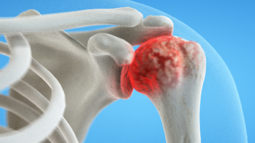 Rotator Cuff Tears, Injuries and Treatments - Cytecare Hospitals