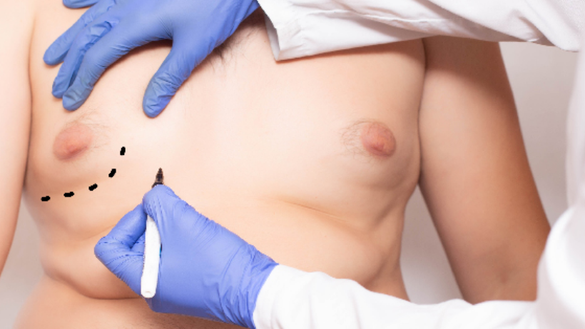 Gynecomastia Surgery To Remove Man Boobs