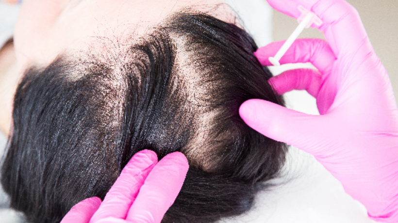 Transplantasi Rambut: Solusi Untuk Kebotakan Anda