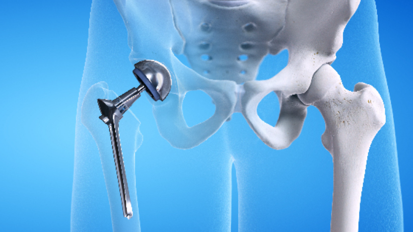 Hip Replacement Surgery 101: A Guide for Patients