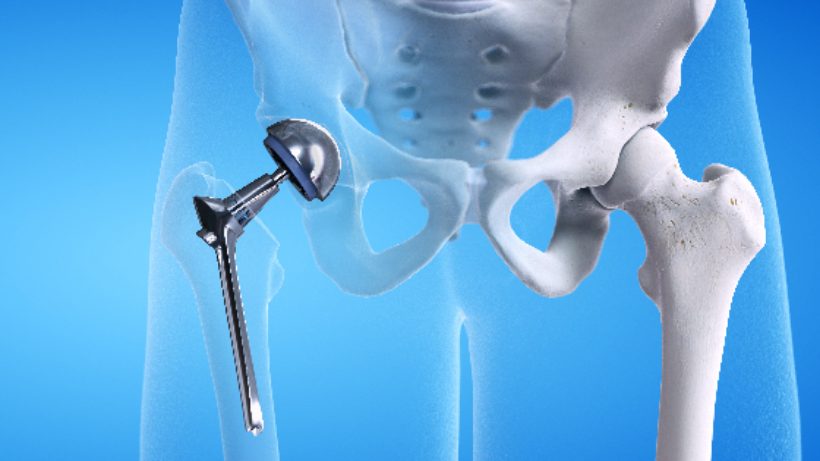 Hip Replacement Surgery Guide - Cost, Recovery Time, Success Rate