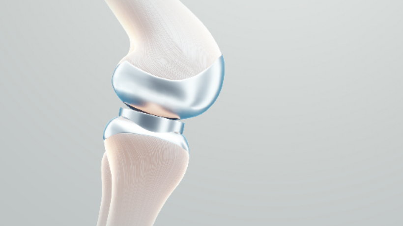 Knee Replacement Surgery: A Permanent Solution For Your Chronic Knee Pain