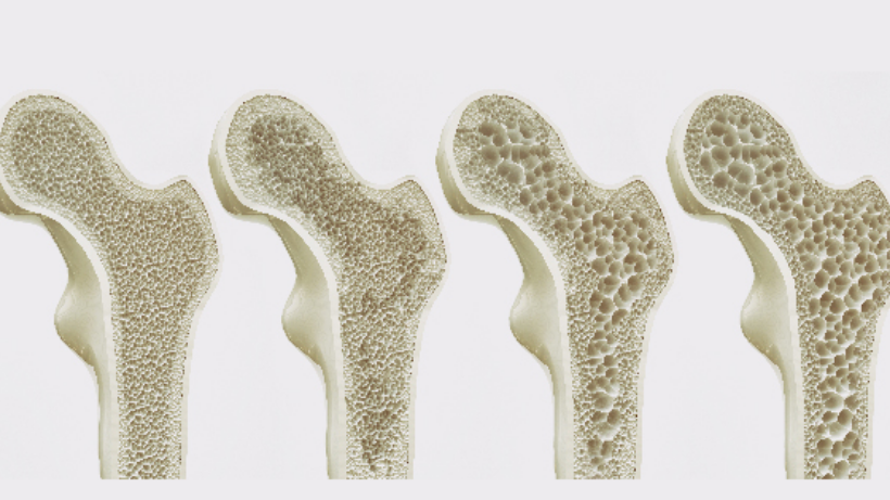 Osteoporosis: What is It? How To Prevent It?
