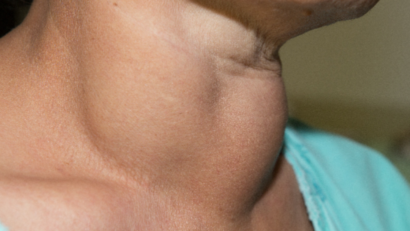 Early Signs and Symptoms of Thyroid Cancer: Know It All