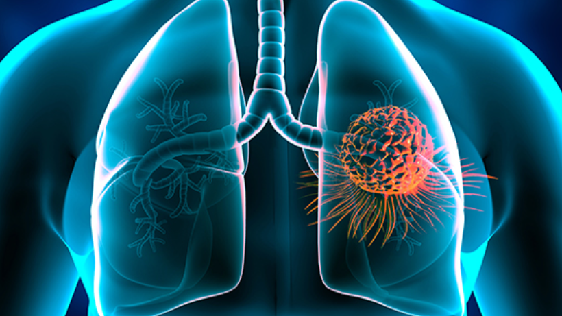 Lung Cancer Surgery Cost- All You Need To Know