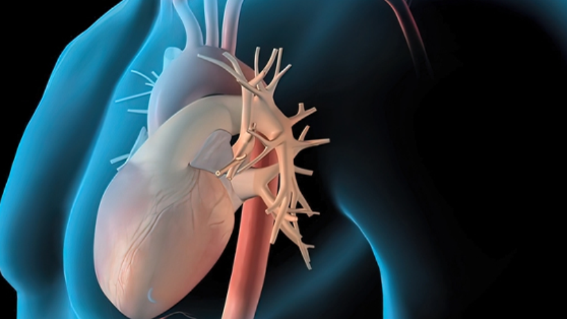 Understanding Complications of Aortic Valve Replacement Surgery