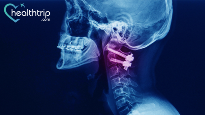 cervical-fusion-failure-symptoms-healthtrip