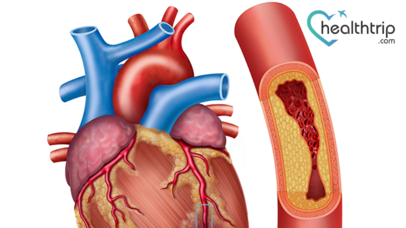 Mengenal Komplikasi Operasi Sakelar Arteri