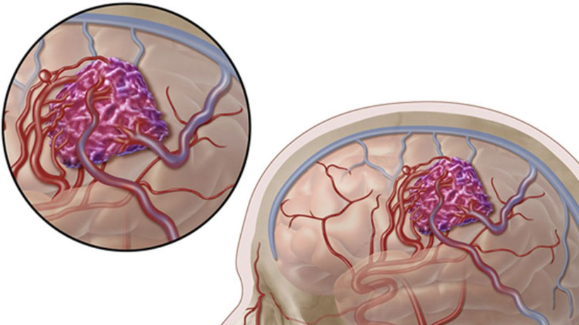 Gejala Malformasi Arteriovenosa Otak yang Perlu Anda Ketahui