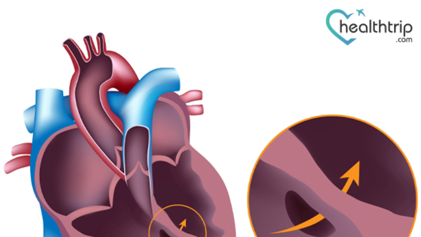 ASD(Hole in the Heart): Symptoms, Cause, All You Need to Know