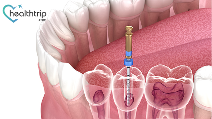A Complete Guide for a Root Canal Treatment