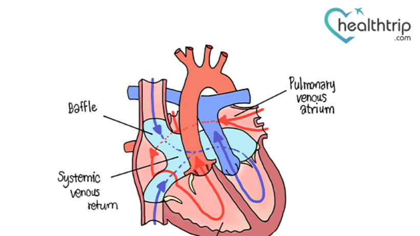 Things to know about Fontan surgery