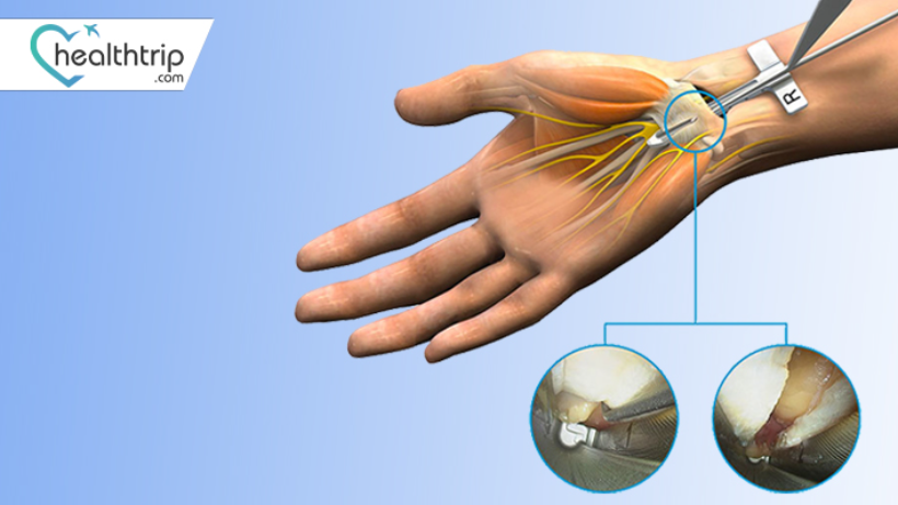 What to Expect During a Carpal Tunnel Release Procedure