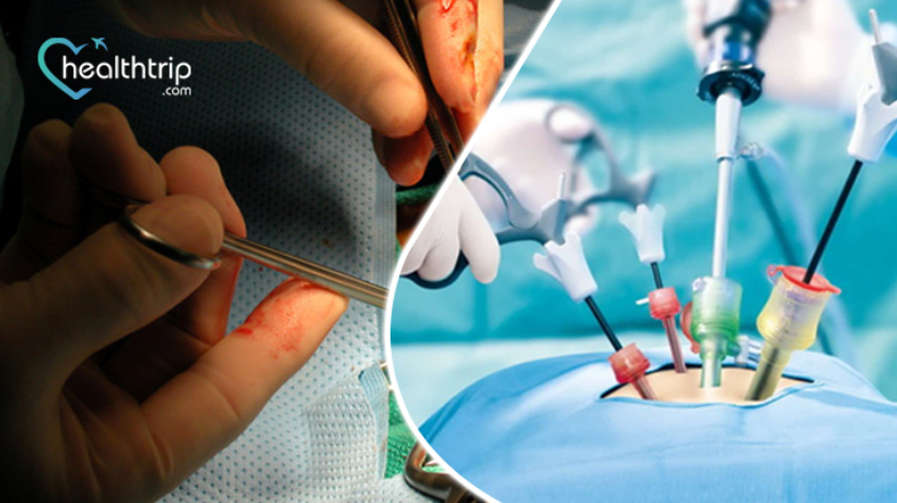 Laparoscopic Surgery Vs Open Surgery Which Is Right For You 4167