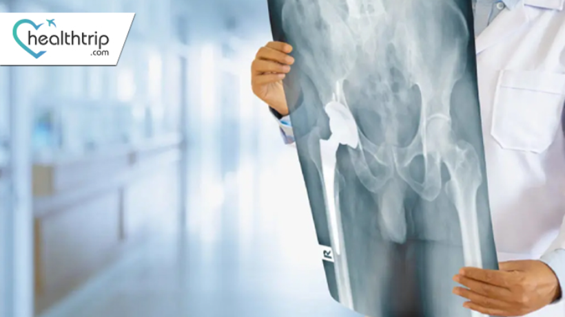 How to Prepare for Hip Replacement Surgery in India?