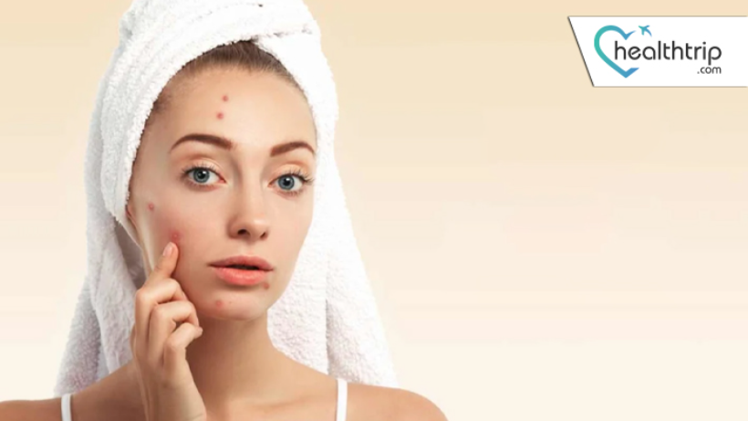 Effective Home Remedies for Acne: Banish Blemishes Naturally