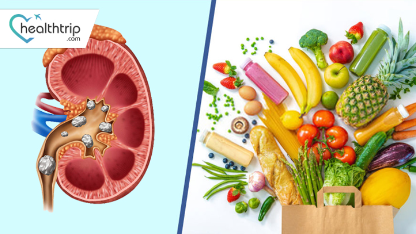 Ang Link sa Pagitan ng Kidney Stones at Diet: Pag-unawa sa Tungkulin ng Nutrisyon sa Paggamot