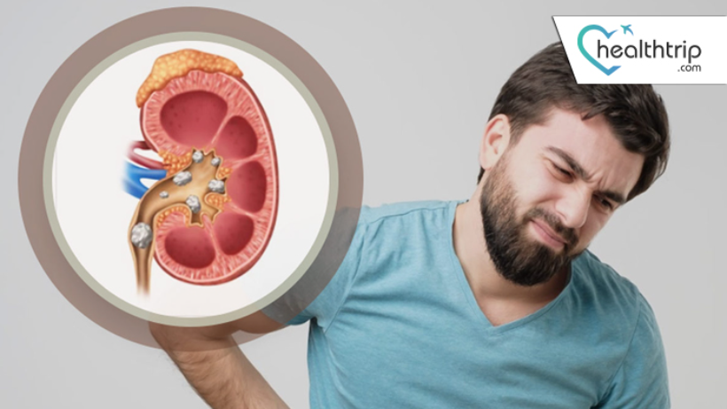 Kidney Stones Treatment in India: Choosing the Right Procedure for Your Unique Needs