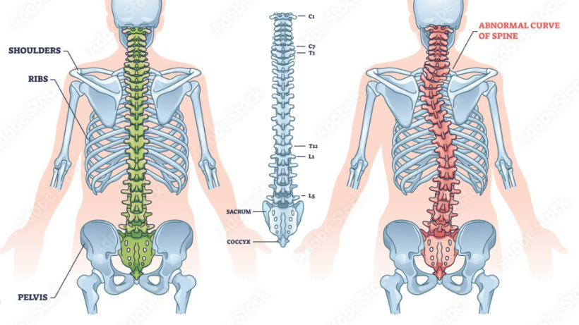 Scoliosis: Anatomy, diagnosis & living with the curve