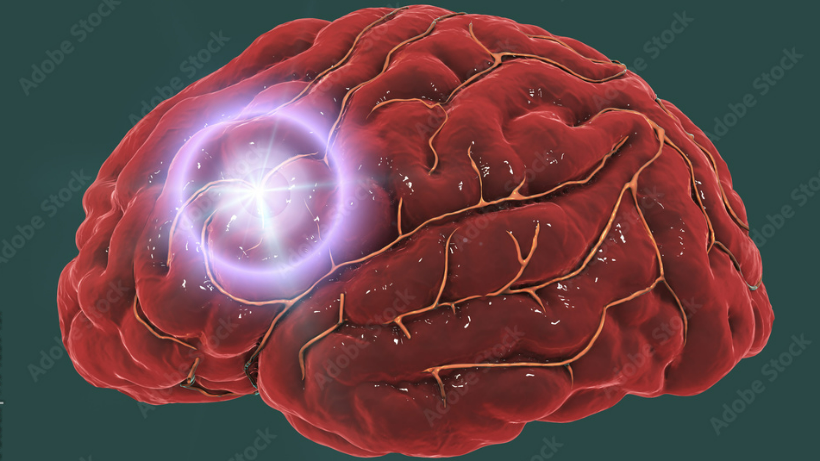 Brain stroke: From causes to rehabilitation