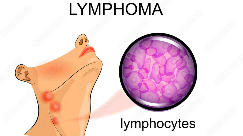 Lymphoma: Symptoms, classifications, and treatments