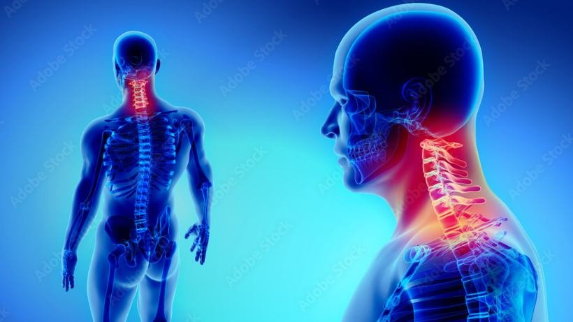 Cervical spondylosis: Causes, symptoms, and prevention