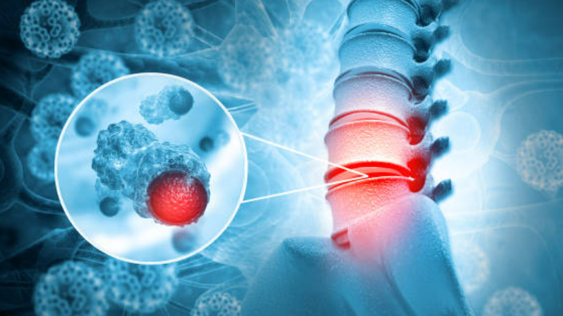 Understanding bone tumors: Types, causes, and treatments