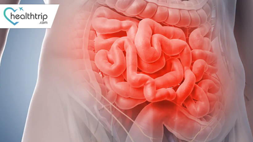 Understanding Crohn's Disease: Causes, Symptoms, and Treatment