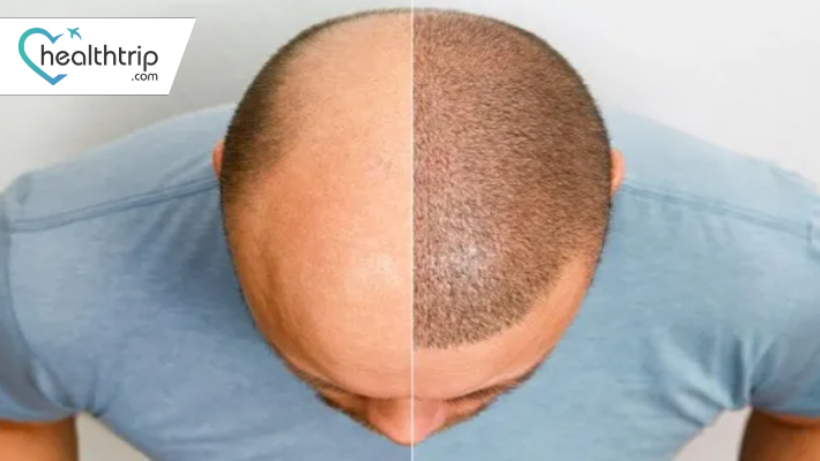 Hair Transplant Procedures: A Growing Trend Among Iraqi Men in Thailand 