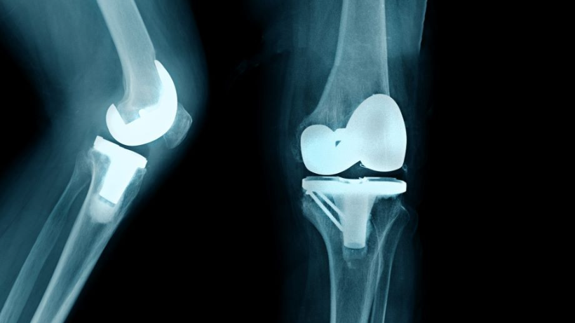 Understanding Bilateral Replacement Surgery: Knee Revival