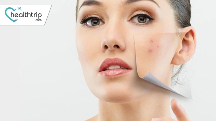Acne-Free in the City of Angels: Solutions in Bangkok