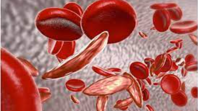 Sickle Cell Anemia: Causes, Symptoms, and Treatment
