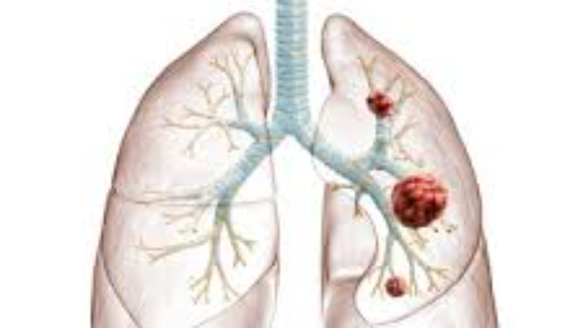  Lung Carcinoid Tumors: Symptoms, Diagnosis, and Treatment