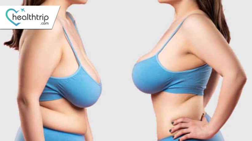 Commonly used Breast Lift Techniques
